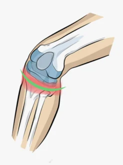 Kniebandage